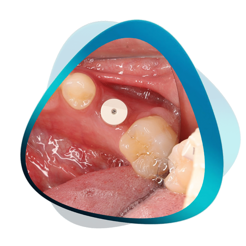 Digital Implantology Bundle
