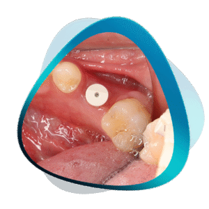 Digital Implantology Bundle